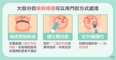 內外痣|痔瘡治療方式怎麼選？外痔與內痔的症狀、治療、術後。